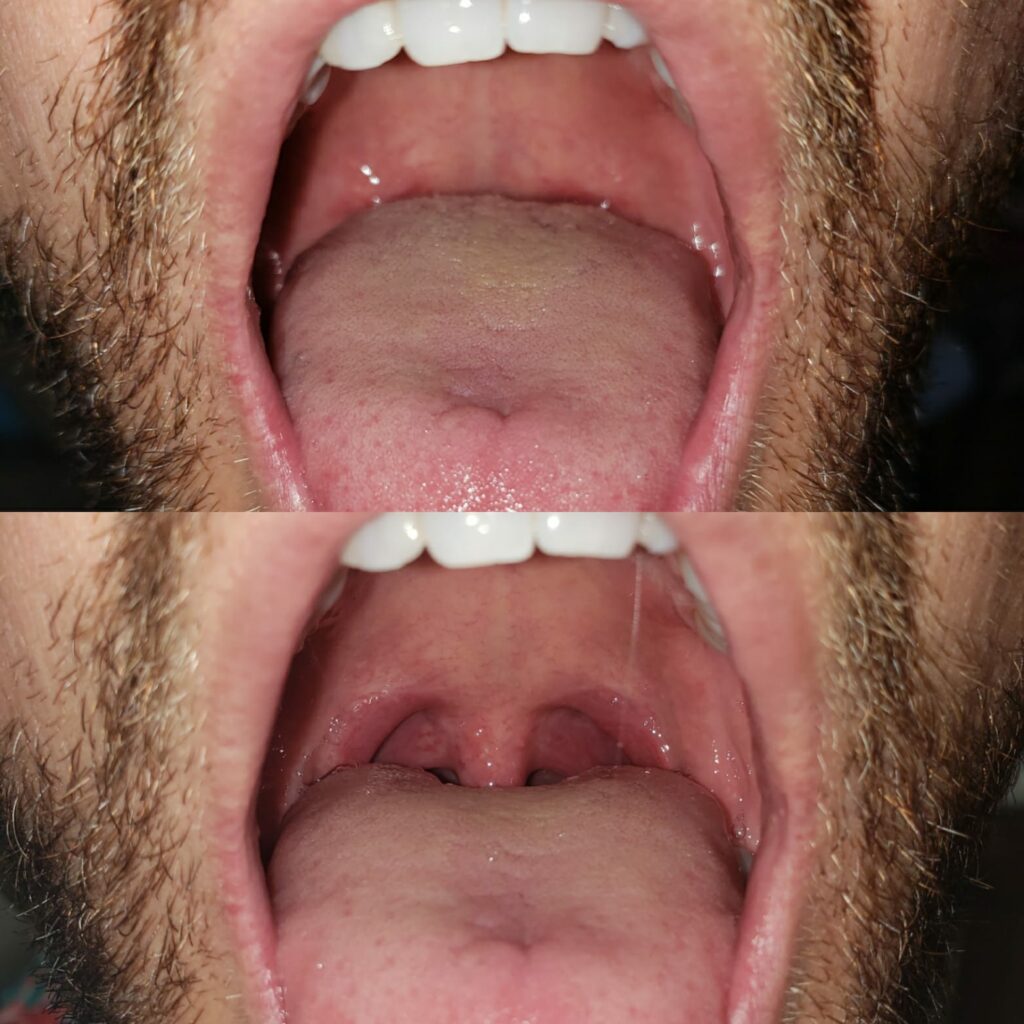 Back of Throat Open After Treatment