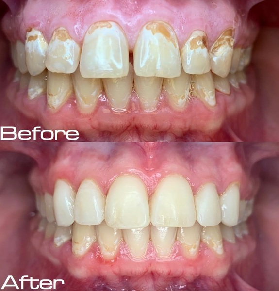 Patient is super happy to have their smile back