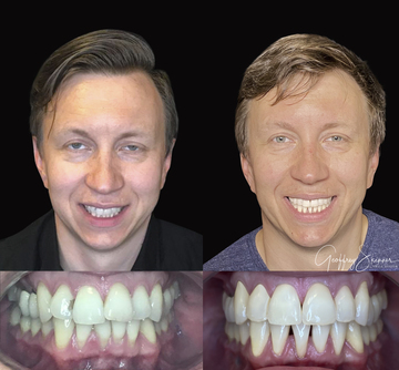 Invisalign Smile to Everyone