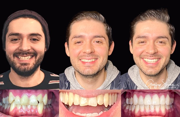 Before and After Veneers