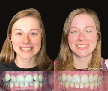 Invisalign Smile