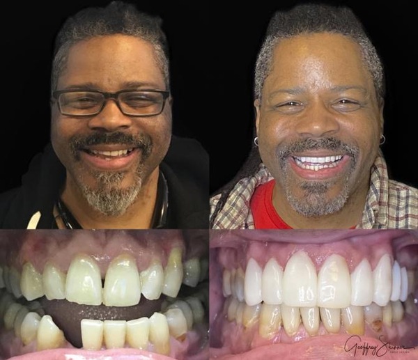 Robert's New Smile