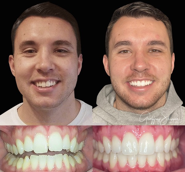 Invisalign Clear Braces Before and After - Hillsboro Dental Excellence