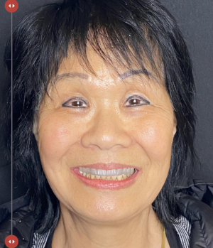 Digital Smile Design Step 3 at Hillsboro Dental Excellence