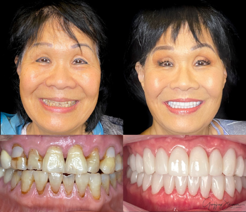 Digital Smile Design Step 4 at Hillsboro Dental Excellence