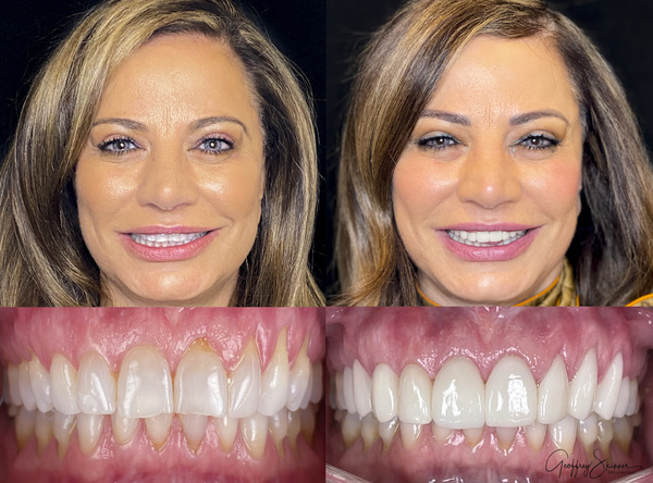 Suzanne's New Smile