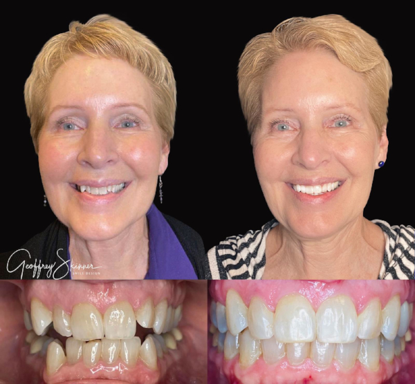 Invisalign for a good smile