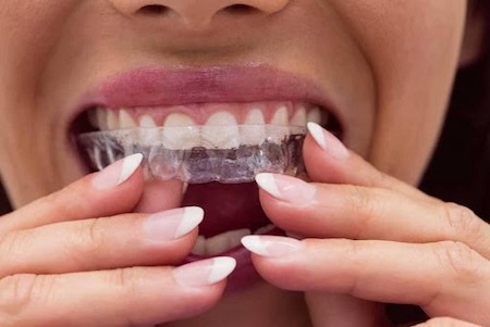A woman wearing Invisalign invisible braces.