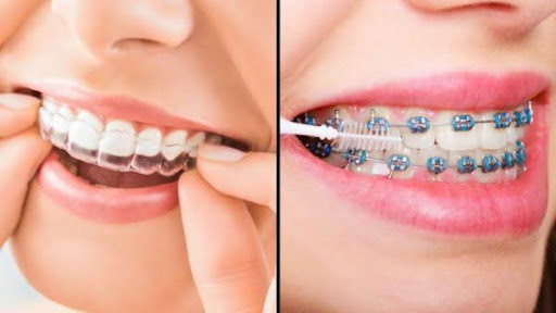 An image showing the difference between Invisalign vs traditional braces.