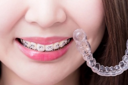 A woman with traditional braces showing Invisible braces.
