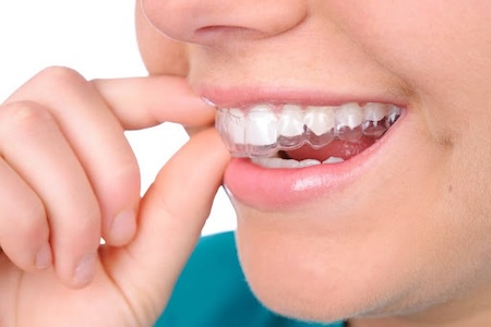 A woman with a beautiful smile wearing her Invisalign braces.
