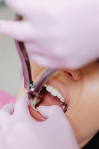 Dentist performing tooth extraction procedure