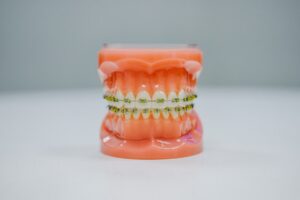 Dental model with braces on teeth