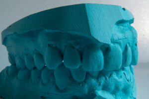 Blue dental mold showing teeth impression