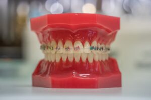 Dental model with colorful orthodontic braces